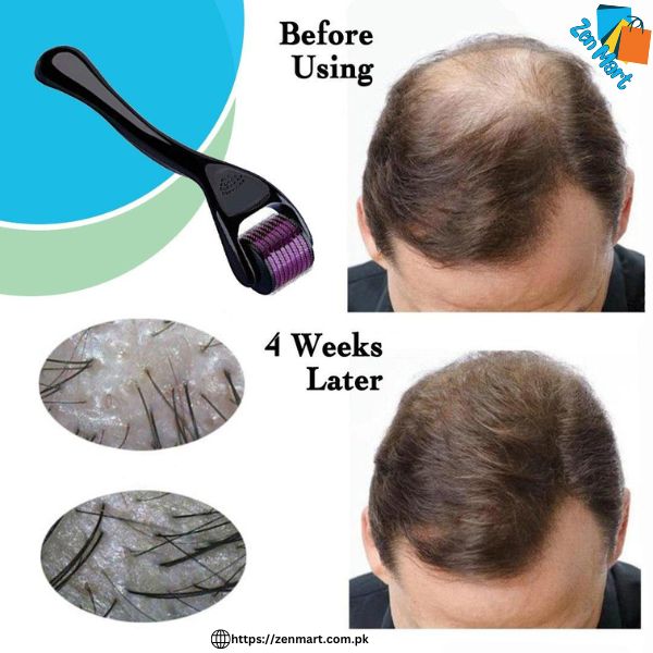 Derma Roller For Hair Loss Treatment Price in Pakistan